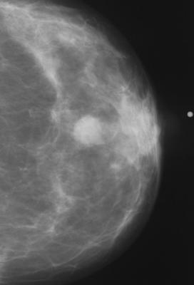 Figure 8. Abnormal mammogram.