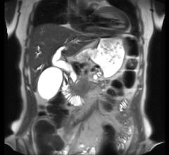 Existing methods for preoperative diagnosis of lymph node metastasis are inadequate. 