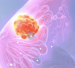 BSC coordinates QUSTom, the first project that will use supercomputing to detect tumors more effectively and safely. The new imaging modality will improve breast cancer diagnosis and potentially replace mammograms